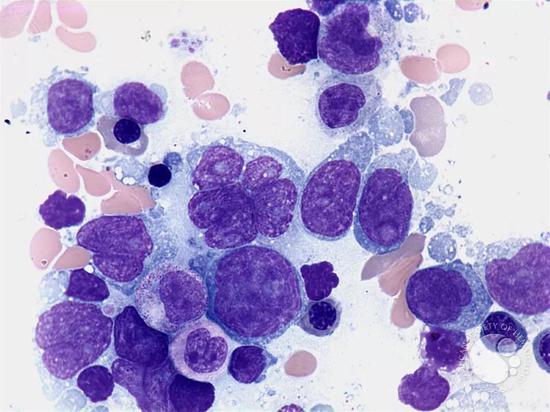 ▲ 弥漫性大B细胞淋巴瘤（图源：imagebank.hematology.org）